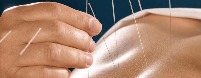 Dry Needling par Benjamin Muck Kinésithérapeute